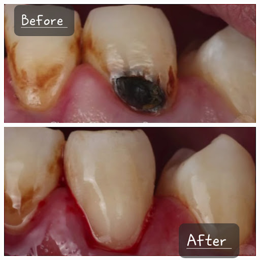 Restoration by using tooth colour composite post image