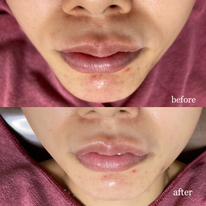 Hana Total Care 名古屋栄/矢場町/ララピール/小顔/毛穴ケア/コルギ/ヘッドスパ