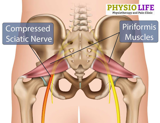 Piriformis syndrome causes pain or numbness in your butt, hip or upper leg. It occurs when the pi… post image