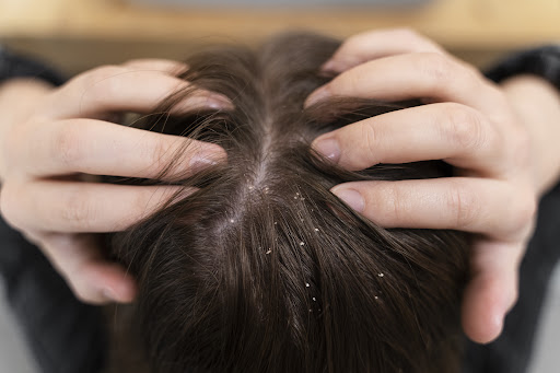 Dealing with constant itching and flaking? Dandruff is a common scalp condition caused by dry ski… post image