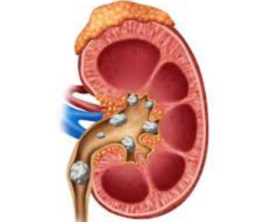KIDNEY STONE post image