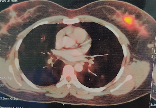 #breastcancer #oncologist #oncosurgeon #cancer #breastlump
