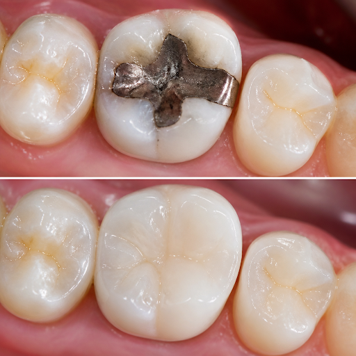 Composite tooth-coloured fillings are a gentle, modern way to repair decayed or chipped teeth whi… post image