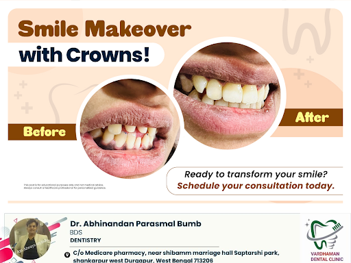 Enhance your smile with dental crowns! Crowns are a great solution for restoring damaged or disco… post image