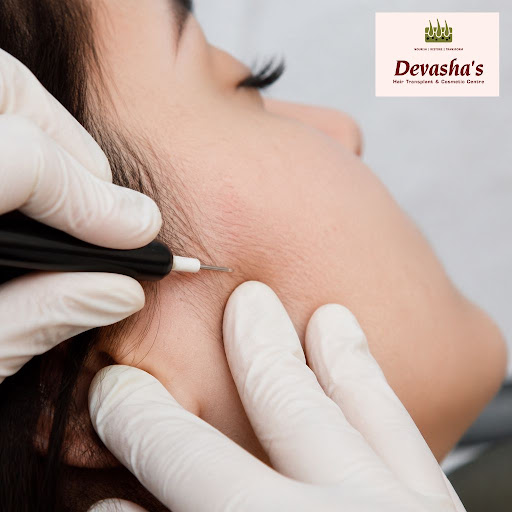 Tired of waxing, threading and repeated laser sessions? At Devasha's Hair Transplant And Cosmetic… post image