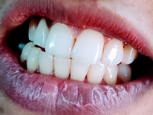 Scalling and polishing post image