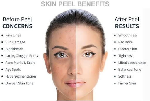 30 % offer on chemical peel post image