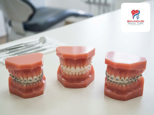 Crooked or crowded teeth can affect your smile, confidence, and oral health. At Bhandari Dental C… post image