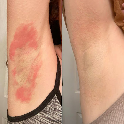 Say goodbye to underarm rashes, redness, itching, and pigmen