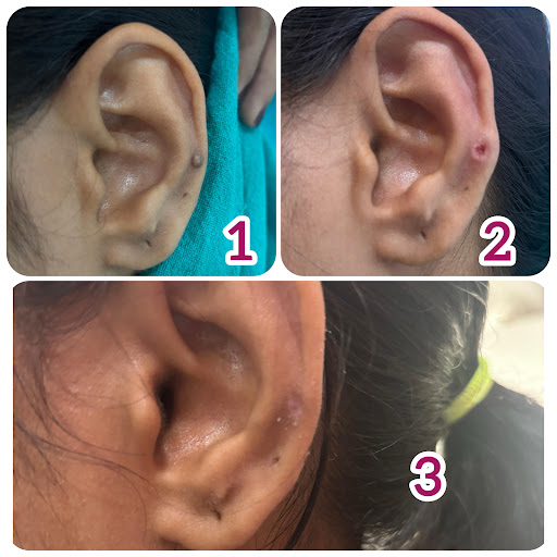 A foreign body granuloma is a type of chronic inflammatory response that occurs when the body tri… post image