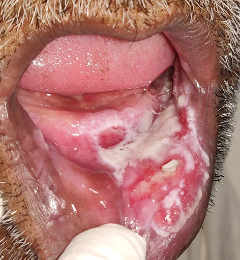 1. **Oral Cancer Risk:** The combination of tobacco and areca nut in gutkha significantly increas… post image