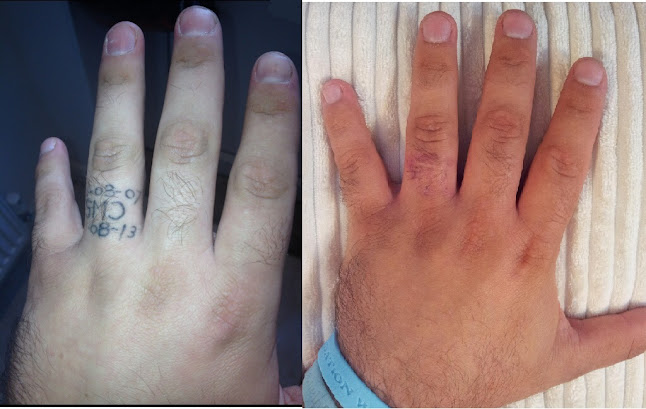 Comments and reviews of Derby Tattoo Removal