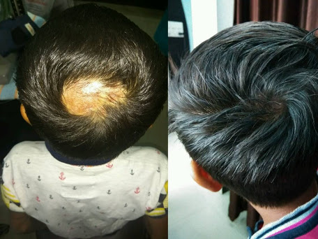 ALOPECIA - HAIRFALL post image