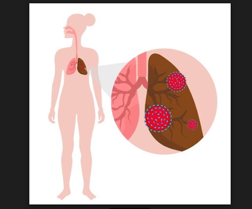 Dr. Ashish Kumar, a renowned pulmonologist and respiratory medicine expert in Delhi NCR, speciali… post image