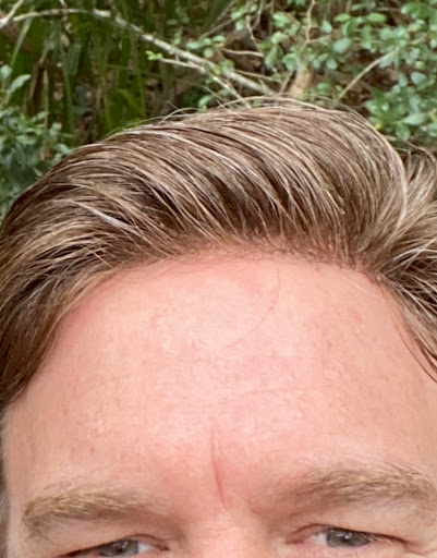 Man Hair - Hair Replacement Solutions Gallery - United States