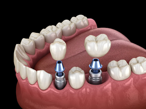Missing teeth can significantly impact your smile, chewing ability, and self-confidence, making d…