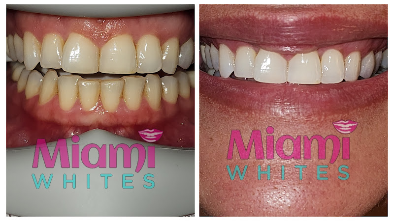 Miami Whites Teeth Whitening