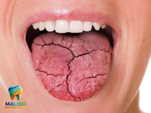 Clinical Treatment for Chronic Dry Mouth (Xerostomia) post image