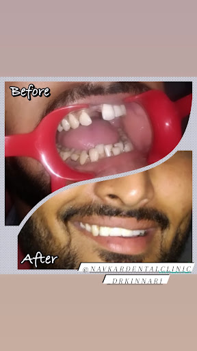 Looking For Best Treatment For Missing Teeth ? Visit the Best Dental Clinic In Manjalpur Vadodara