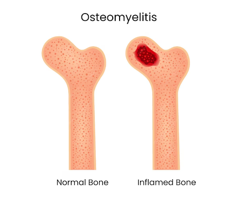 Understanding the symptoms of osteomyelitis, such as persistent pain, swelling, and fever, is cru… post image