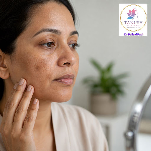 Struggling with dark patches on your face during pregnancy, after delivery, or due to hormonal ch… post image