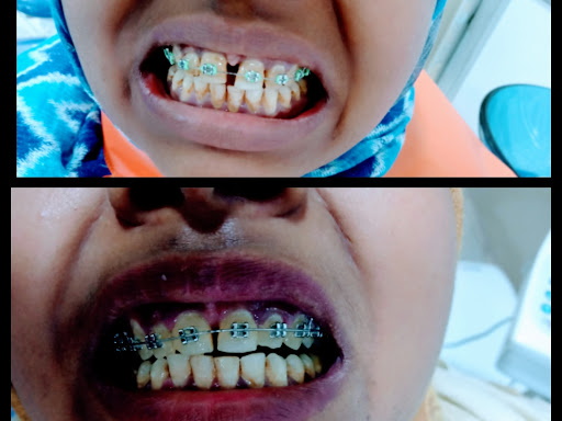 Midline Diastema closer. post image
