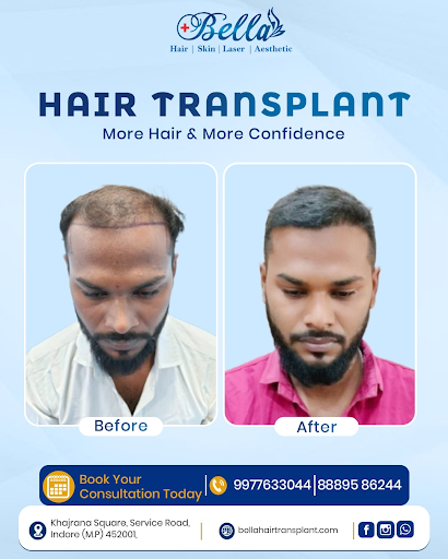 Hair Transplant Near Me – Bella Skin and Hair Transplant post image