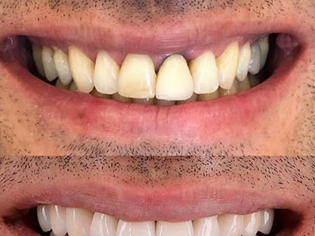 Teeth Whitening & Polishing post image