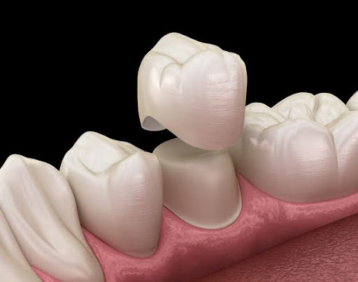 Restore Your Smile with Confidence and strengthen your tooth structure– Discover the Power of Den… post image