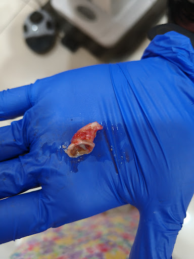 48 extraction done post image