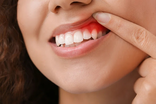 Gum Treatment is focused on maintaining healthy gums and addressing problems such as redness, swe… post image