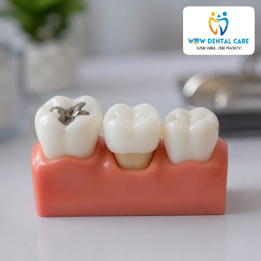 Not every damaged tooth can be saved with a simple filling. Sometimes, a dental crown is the safe… post image