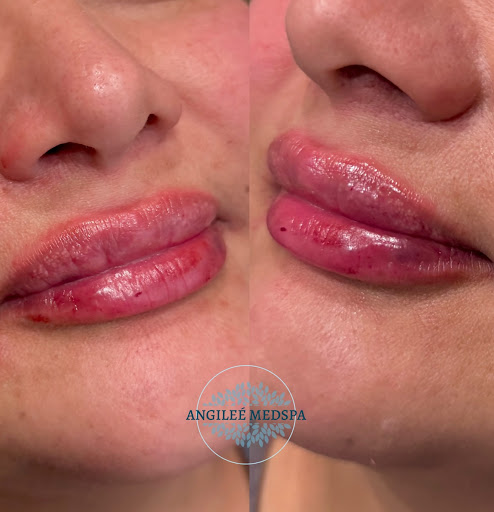 Angileé Med Spa