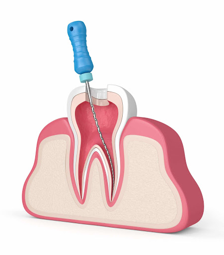 Struggling with a severe toothache that disrupts your day? Ignoring it can lead to infection or e… post image