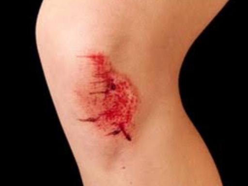 Wounds 