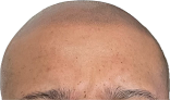 Hair transplant clinic Natural Effect (scalp Micropigmentation Okc) in Moore