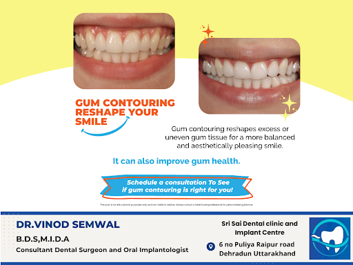 Gum contouring is a cosmetic procedure that reshapes uneven or excess gum tissue, creating a more… post image