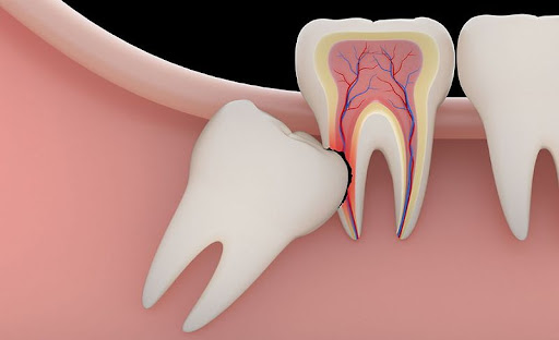 Busy schedule but suffering from tooth pain? At Dr. Gophane Dental Clinic and Implant Center, we… post image