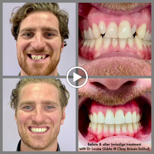 Clear Braces Solihull