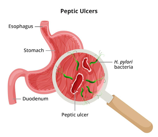 Peptic ulcers can be painful and disruptive, but Ayurveda offers natural, effective remedies. Her… post image