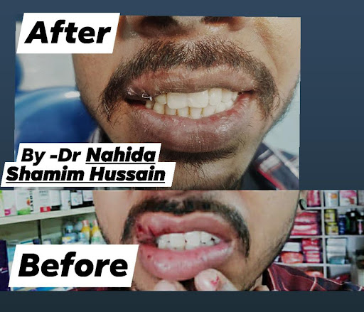 Before and after treatment of a fractured tooth. Lip suturing included post image