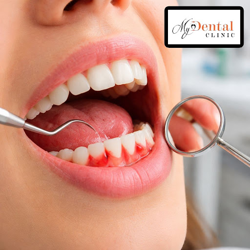 Bleeding gums are often the first warning sign of gum disease, plaque build-up or improper brushi… post image
