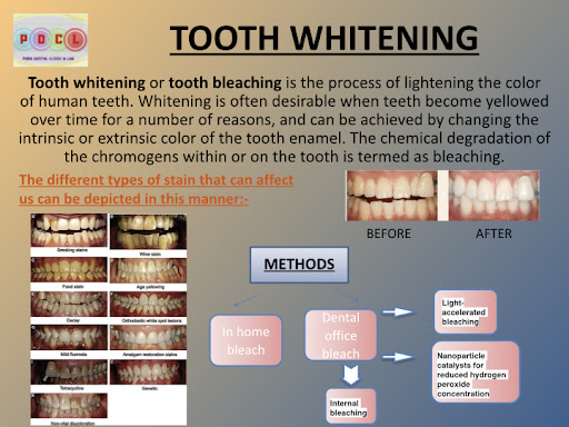 Teeth whitening is a preferred mode of treatment chosen by many individuals especially those work… post image