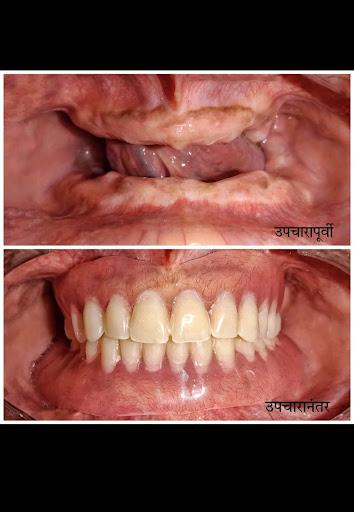 🦷 Complete Denture Treatment – Before & After | Dr. Sumit’s Dental Care post image