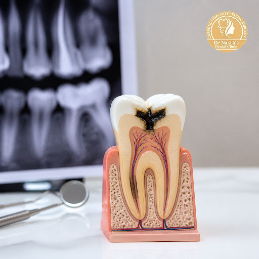 Tooth pain, sensitivity to hot or cold, or visible black spots on teeth are often early signs of… post image