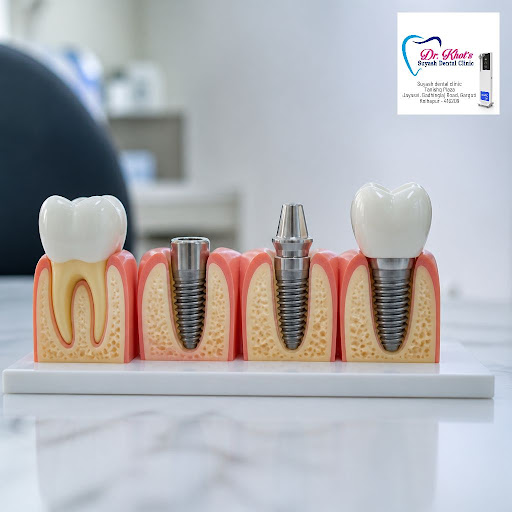 Thinking about replacing a missing tooth but unsure what really happens during a dental implant?… post image