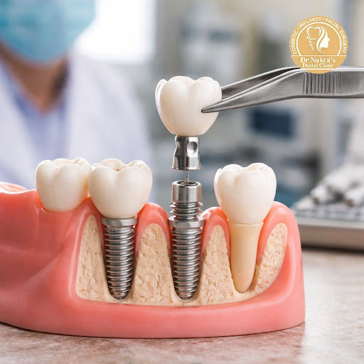 Missing one or more teeth? At Dr Nakra's Dental Clinic in Surya Nagar, Ghaziabad, we offer advanc… post image