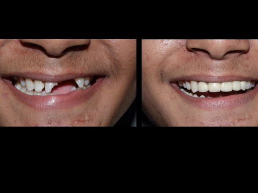 #ceramic #smiledesigning #dentistinahmedabad #dentistinjuhapura post image