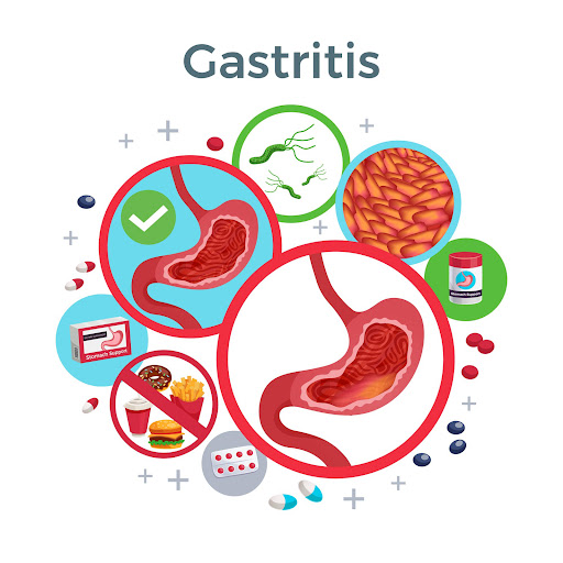 Gastritis occurs when the lining of the stomach becomes irritated or inflamed. It may cause sympt… post image