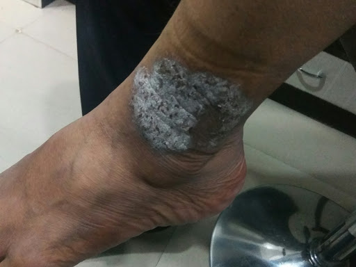 PSORIASIS post image